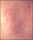 Example of measles rash