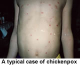 Typical case of chickenpox 